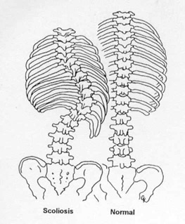 Scoliosis - curved spine